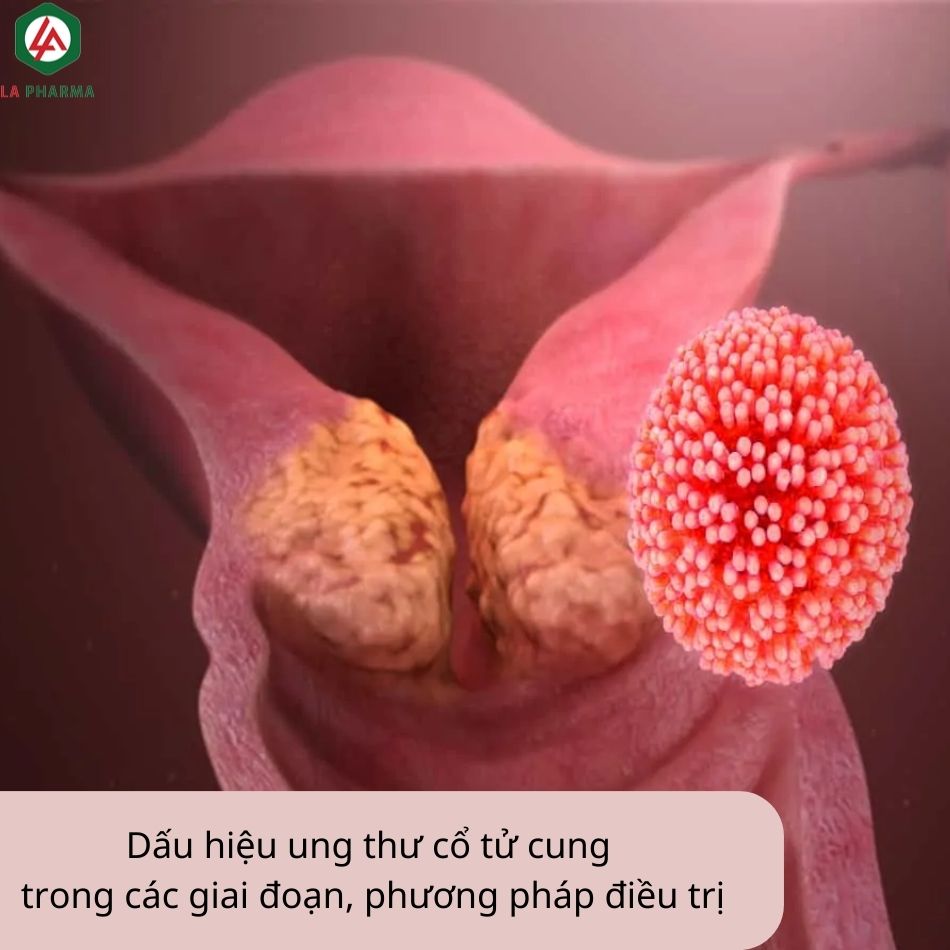 Dấu hiệu ung thư cổ tử cung trong các giai đoạn, phương pháp điều trị